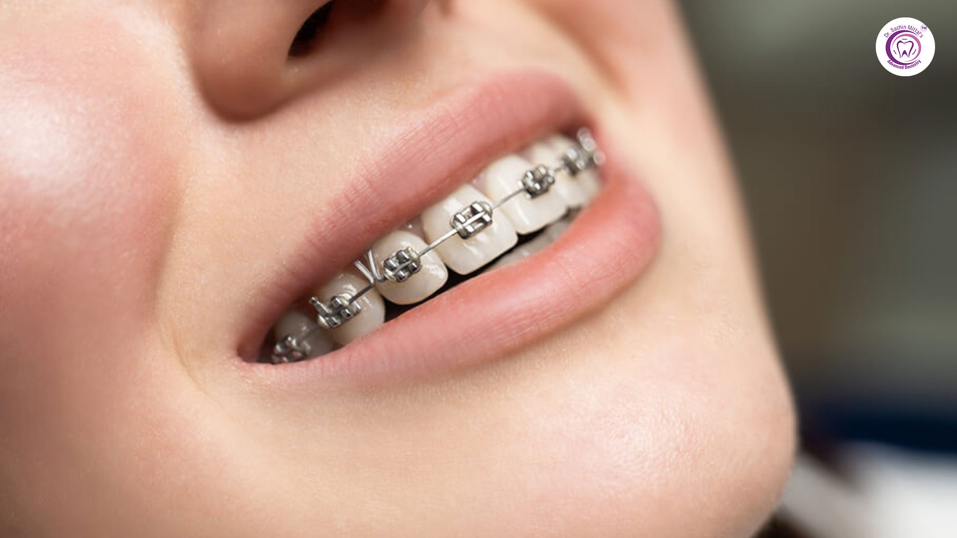 Braces vs Aligners