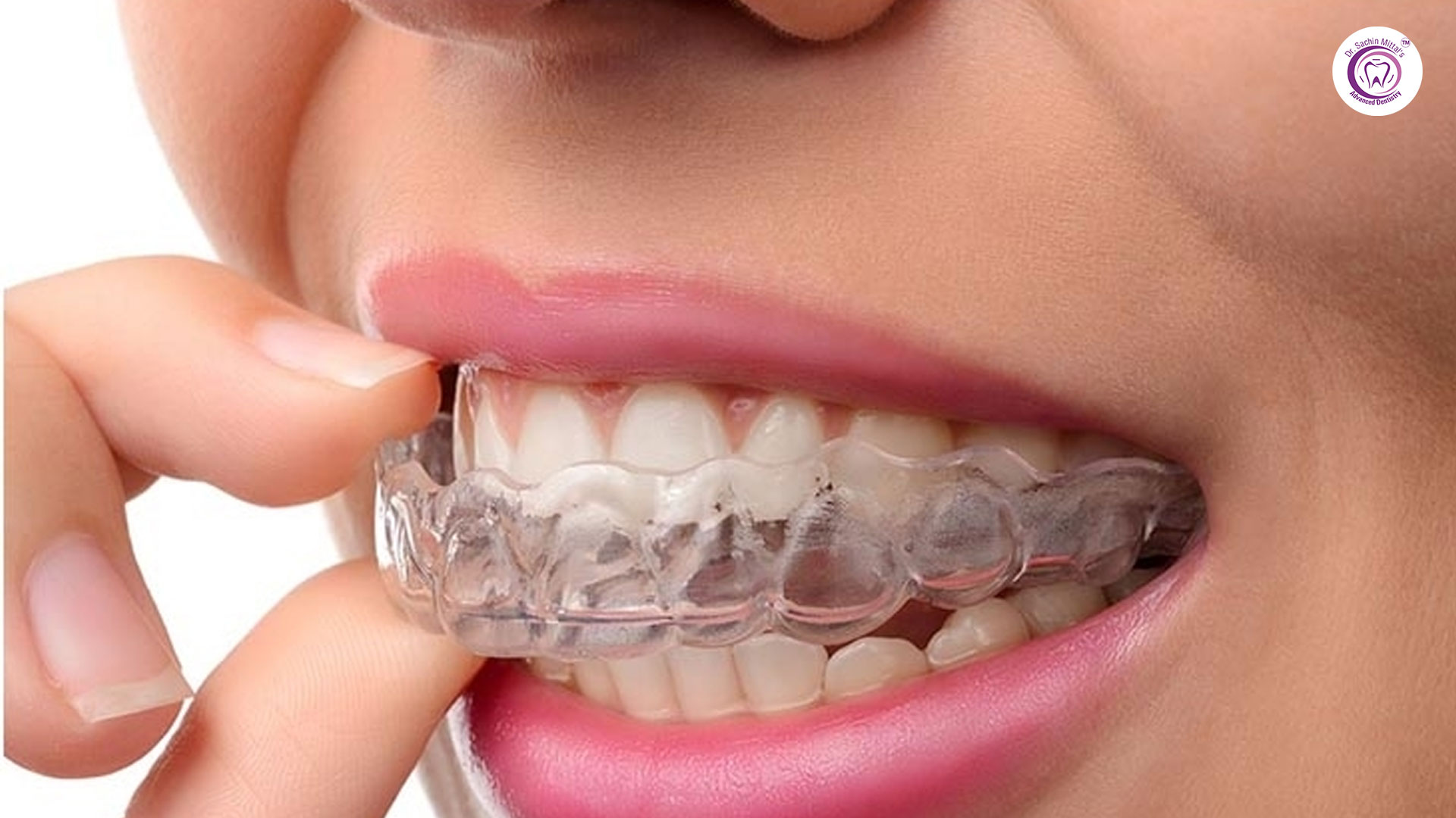 Braces vs Aligners