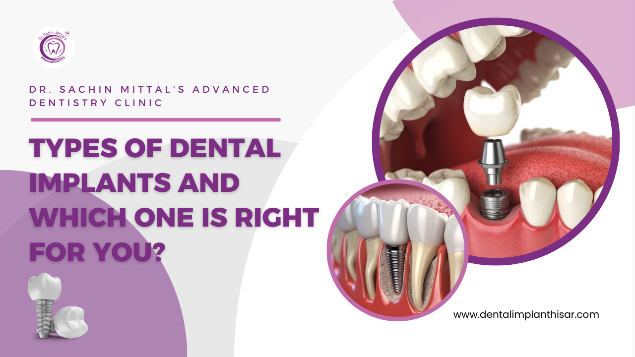 Types of Dental Implants