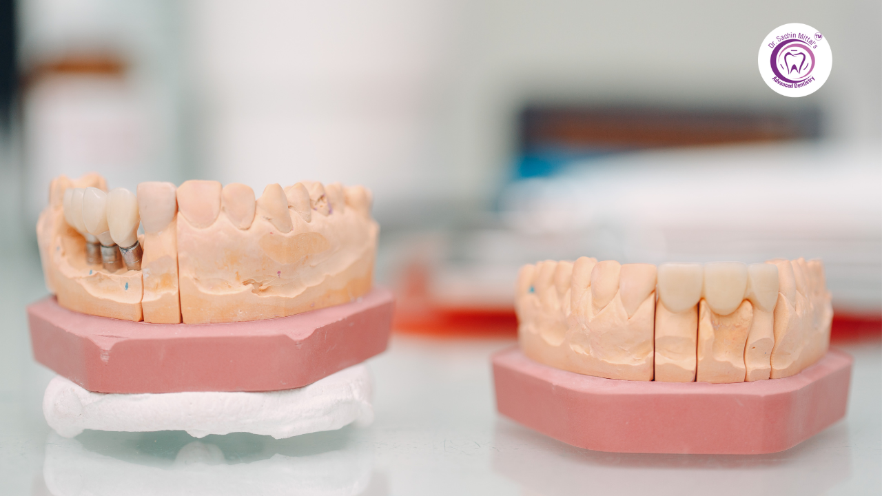 types of dental implants