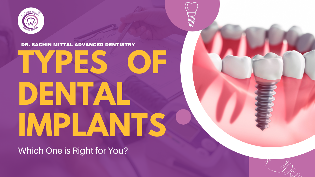 Top 5 Benefits of Dental Implants