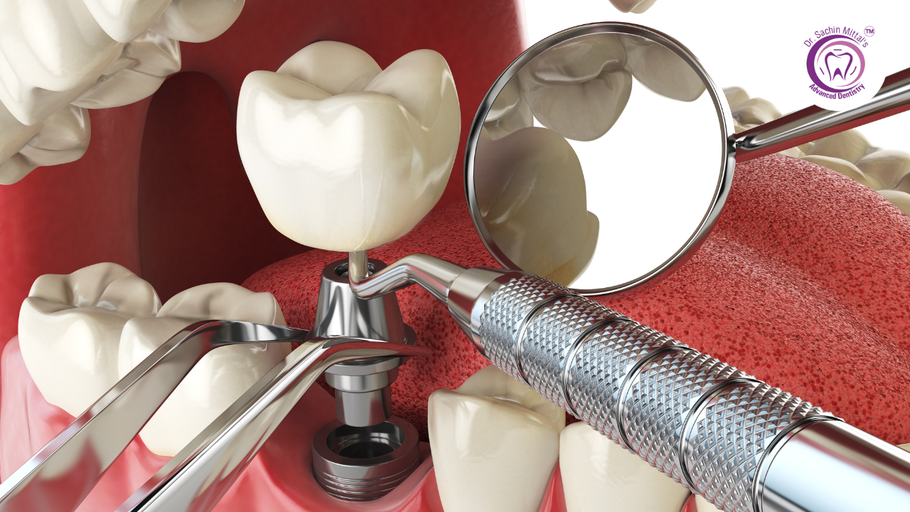 Top 5 Benefits of Dental Implants in hisar