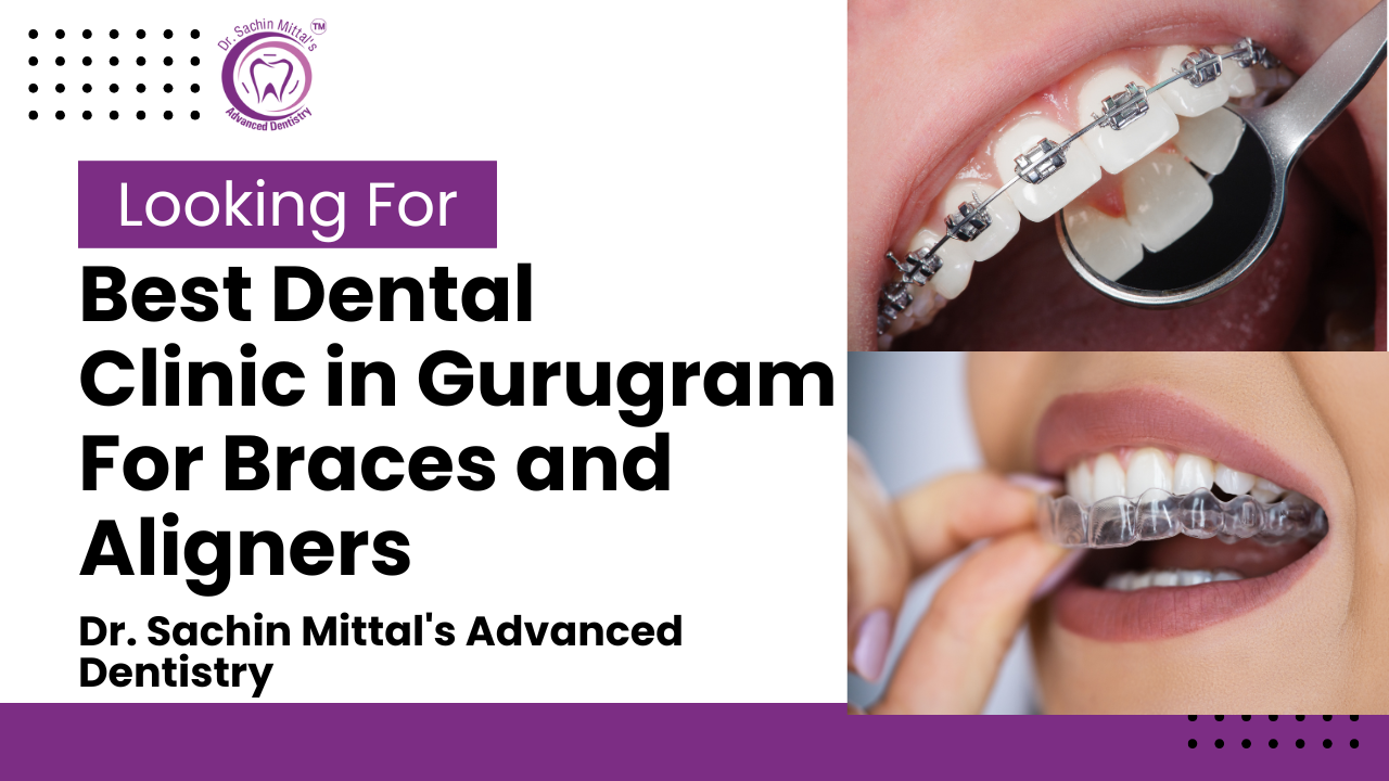 Achieve Your Dream Smile with Braces and Aligners Treatment in Gurugram Sector 52 – Dr. Sachin Mittal Advanced Dentistry