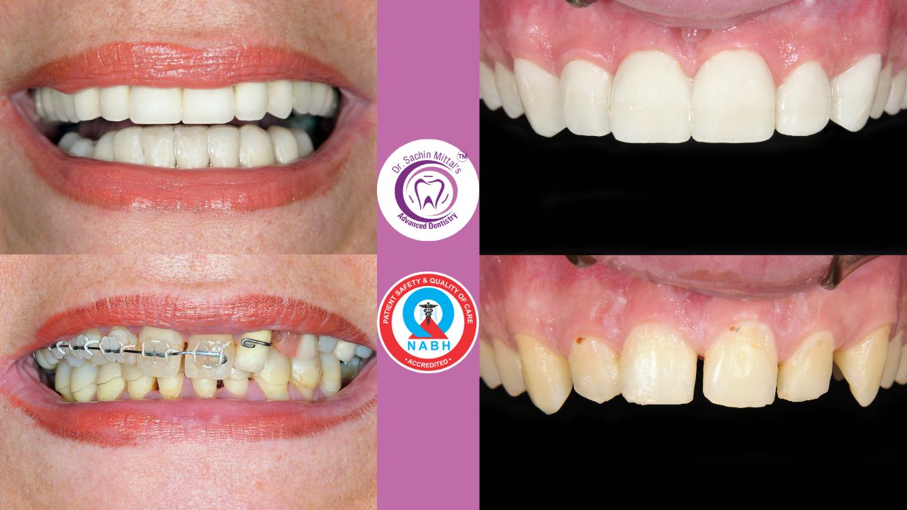 Smile Makeover