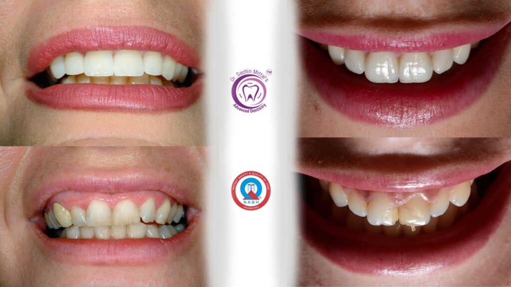 Smile Designing