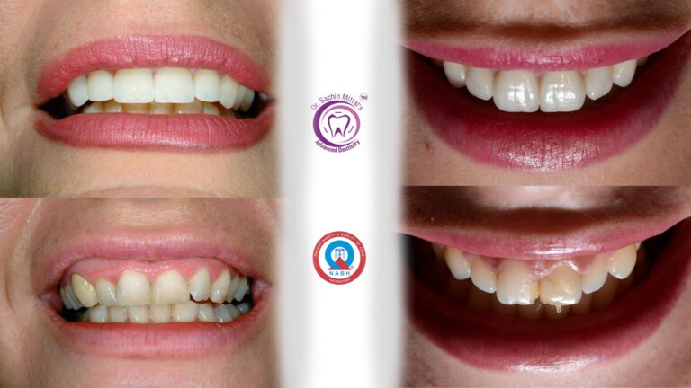 Smile Designing
