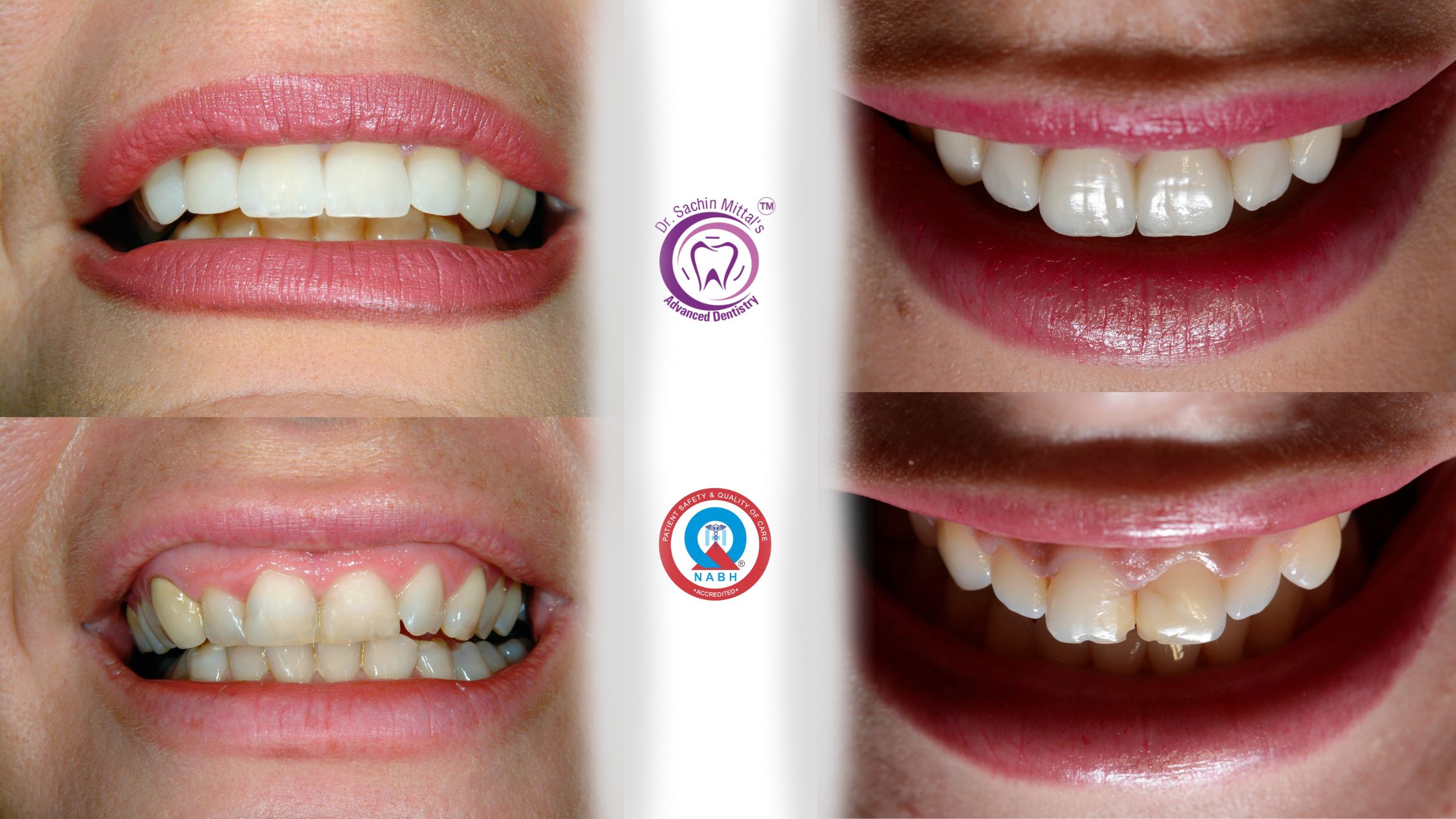 Smile Designing
